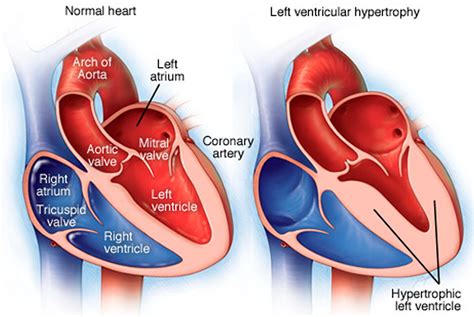 what is mild concentric hypertrophy